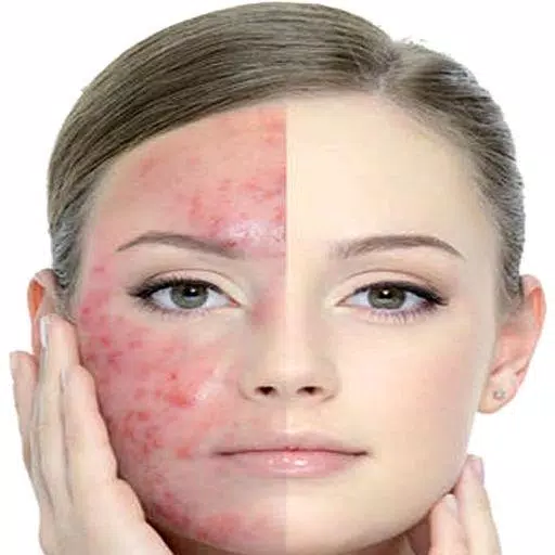 Get Rid of Acne  (Guide) 스크린샷 1